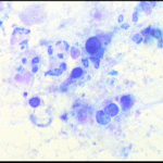 Άτυπα αδενικά κύτταρα στο κυτταρολογικό επίχρισμα του τραχήλου της μήτρας. Ενα δυνητικο πρόβλημα. ι